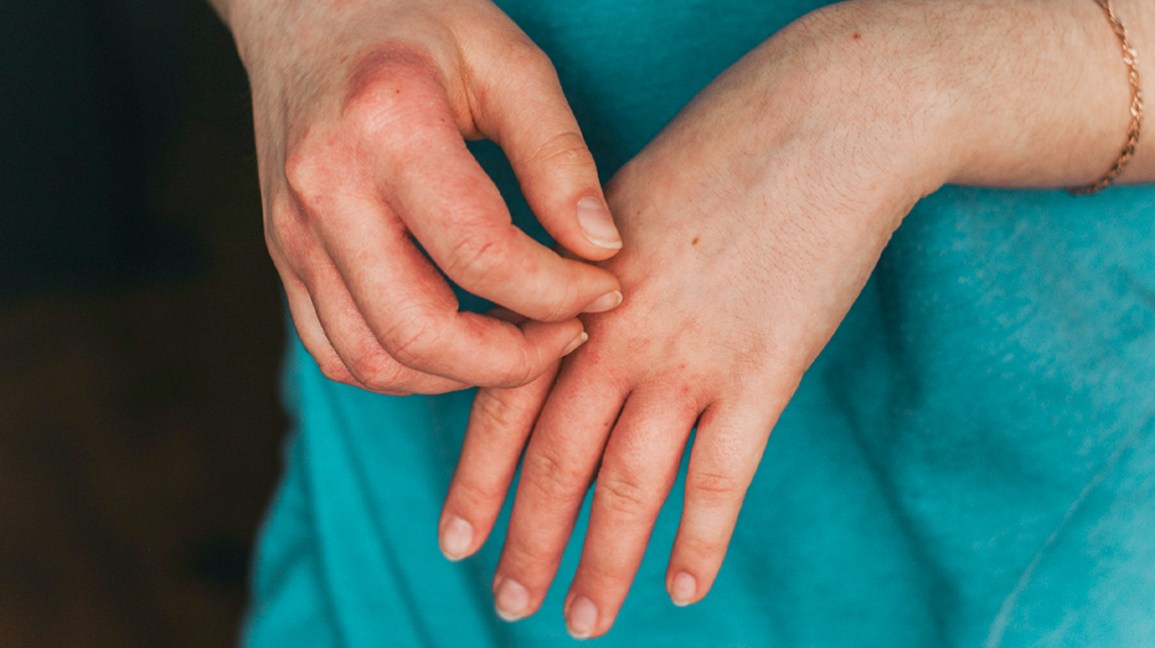 What You Need To Know About Eczema On Skin – Get The Facts