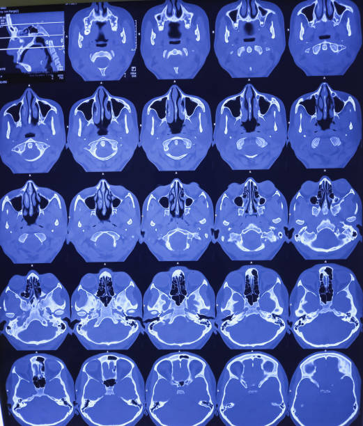 Turbinate hypertrophy